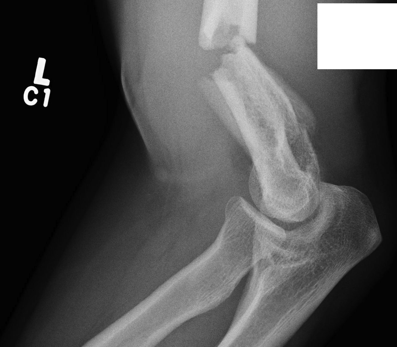 Distal Humeral Fracture Bicondylar